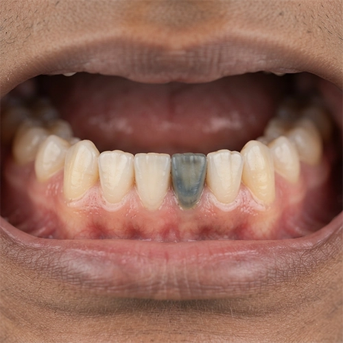 Certain drugs, dental trauma or body changes can cause teeth to become stained.