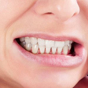 Displays the wear and tear on tooth enamel caused by chronic grinding and clenching