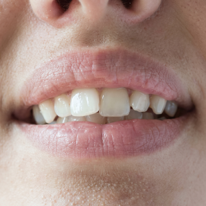 Teeth misalignment causing bite problems and TMJ jaw pain treated in Coimbatore
