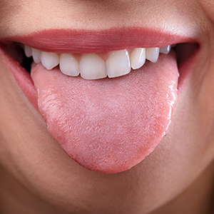 Professional tongue cleaning removes bacteria and food debris buildup, helping reduce bad breath and improve oral hygiene.