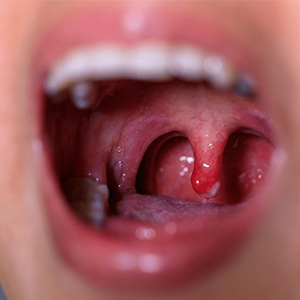 Vitamin C Deficiency and Gum Bleeding