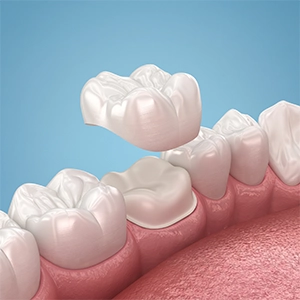 Crowns restore severely discoloured teeth when whitening isn't appropriate.