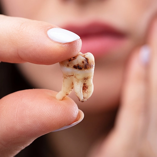 Tooth decay weakening a tooth structure leading to tooth loss