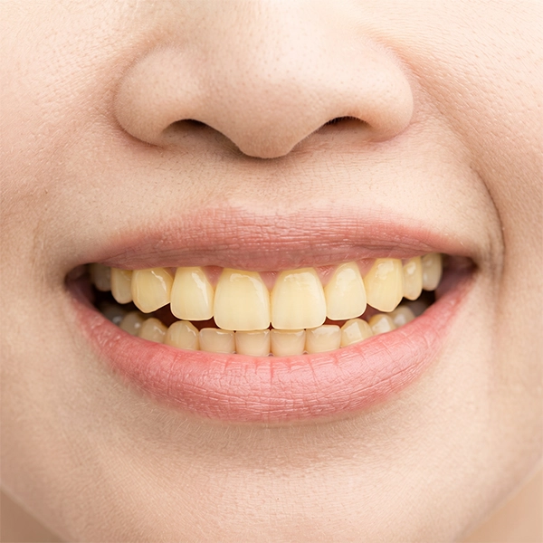 Expert evaluation and treatment for yellow and discoloured teeth at Sri Sakthi Dental Clinic.