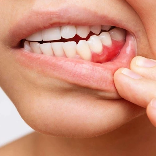 A tooth infection develops when bacteria enter inner tissues and cause severe pain.