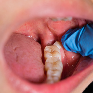 Impacted wisdom tooth creating pressure and jaw pain around TMJ region in Coimbatore