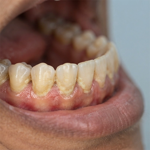 Plaque buildup from poor oral hygiene leads to visible tooth discolouration.