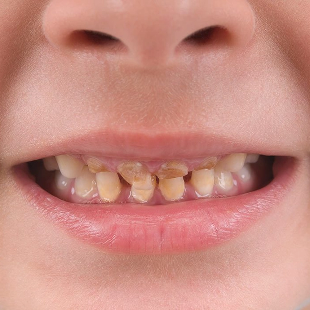 Effective yellow teeth treatment in Coimbatore to restore a bright and healthy smile.